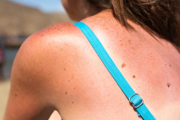 Cuidemos nuestra piel para evitar riesgo de melanoma
